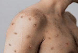 Man covered in monkeypox bumps