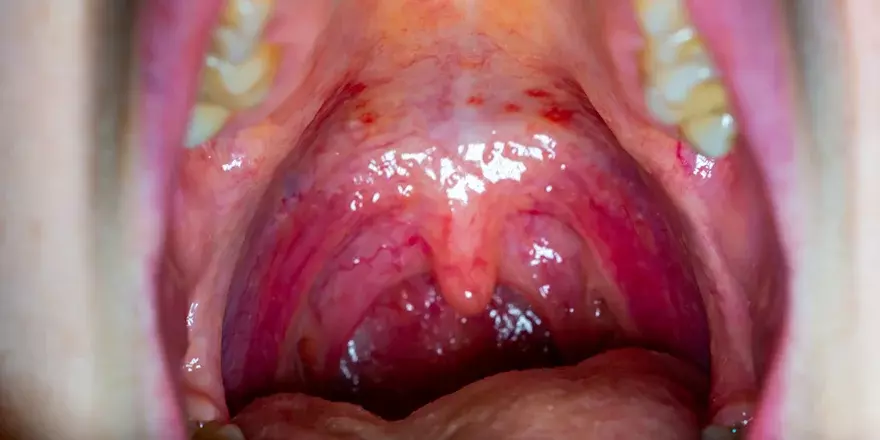 Signs of strep throat, red irritated throat.